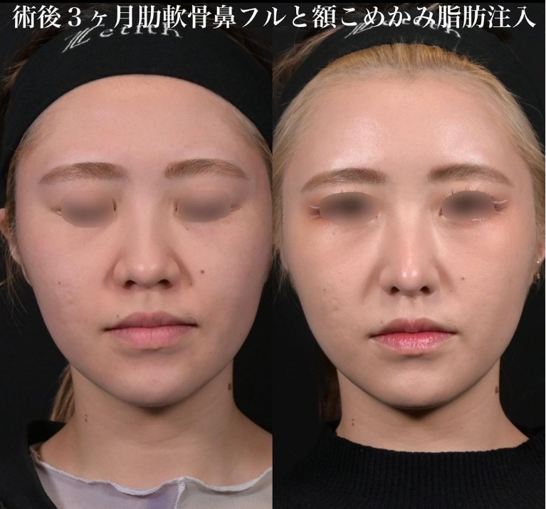 鉄医師による鼻のフルコースの施術前／施術後3ヶ月
