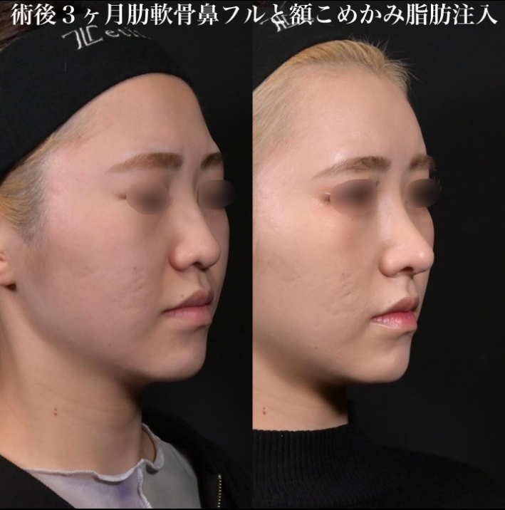 鉄医師による鼻のフルコースの施術前／施術後3ヶ月 术后 
