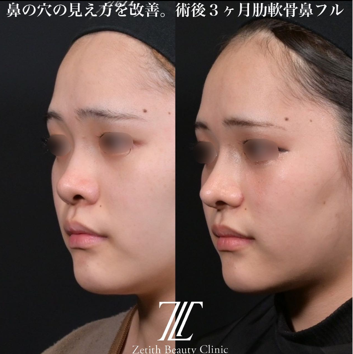 鉄医師による鼻のフルコースの施術前／施術後3ヶ月