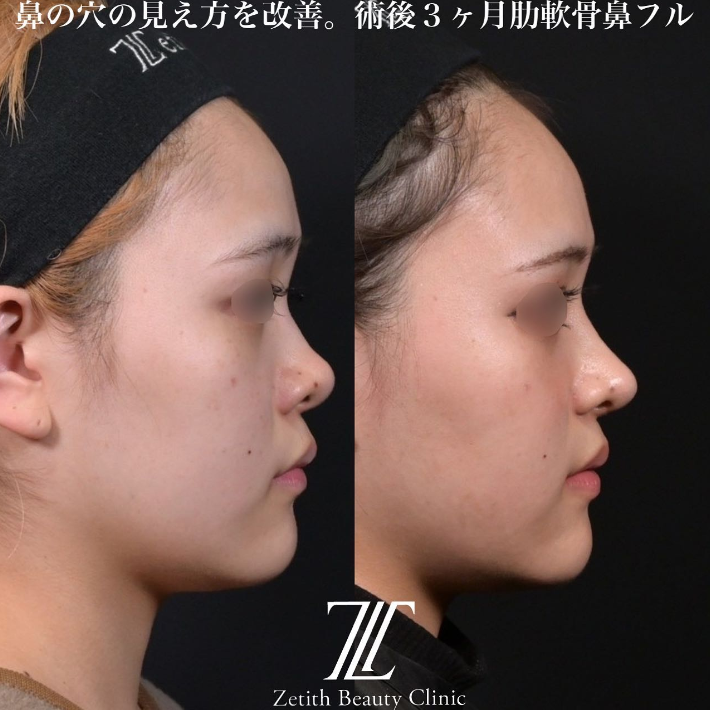 鉄医師による鼻のフルコースの施術前／施術後3ヶ月 Дараа 