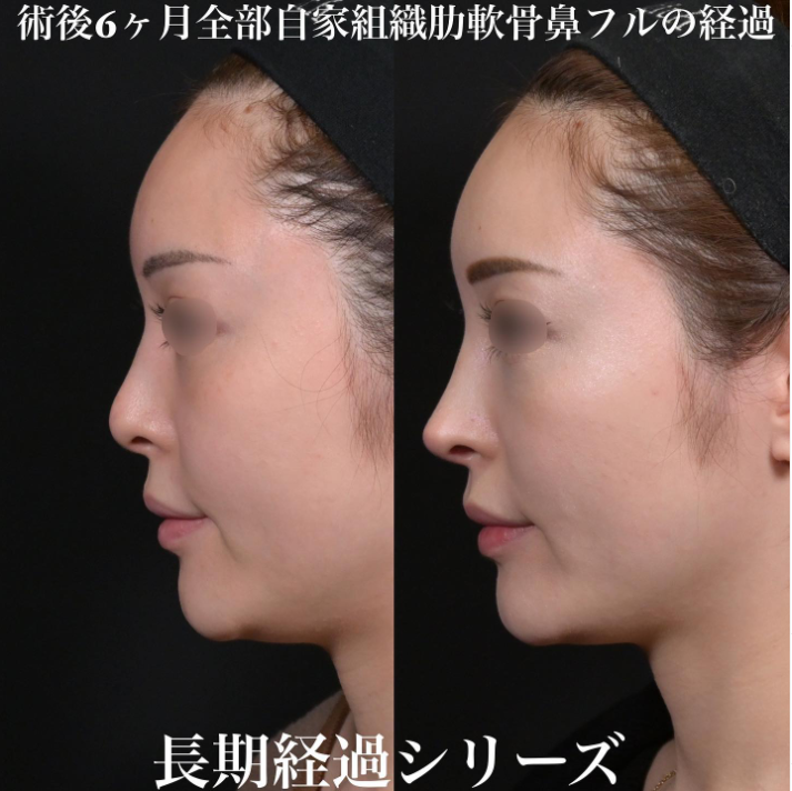 鉄医師による鼻のフルコースの施術前／施術後6ヶ月