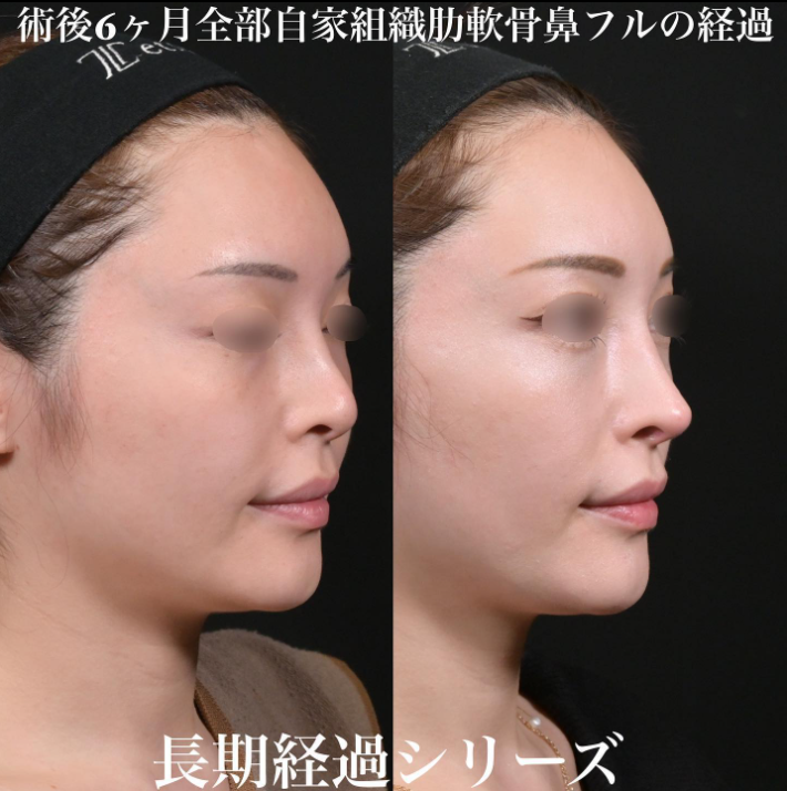 鉄医師による鼻のフルコースの施術前／施術後6ヶ月 施術後 