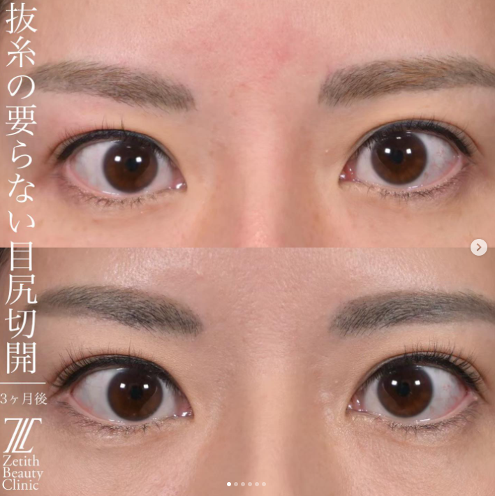 上木原医師による抜糸のいらない目尻切開の施術前／施術後3ヶ月