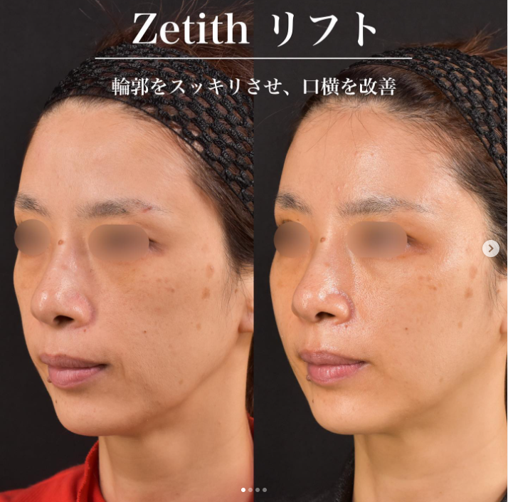 新井医師による糸リフトの施術前／施術後1ヶ月