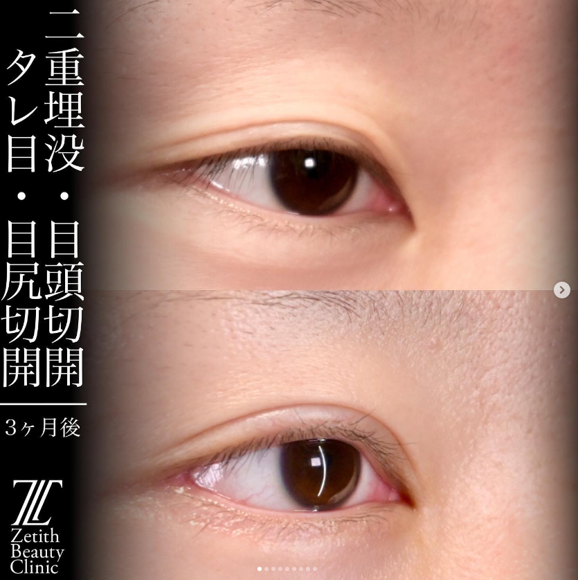 上木原医師による目元複合手術の施術前／施術後3ヶ月