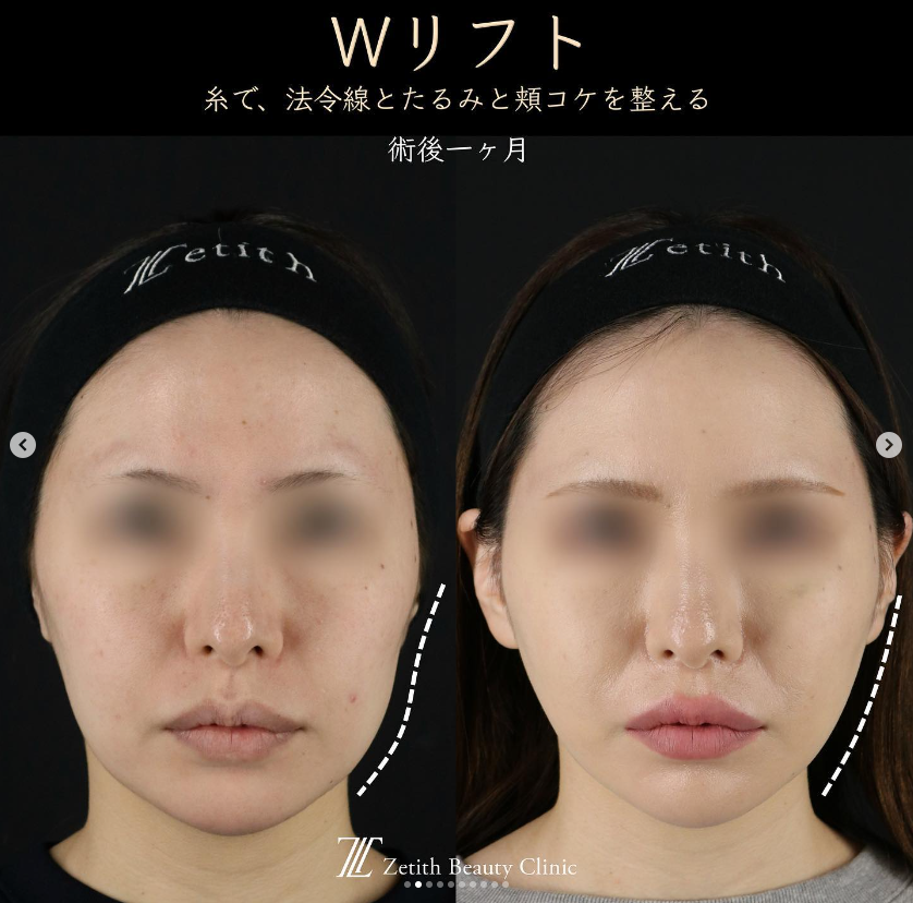 王医師による施術前／施術後1ヶ月 施術後 
