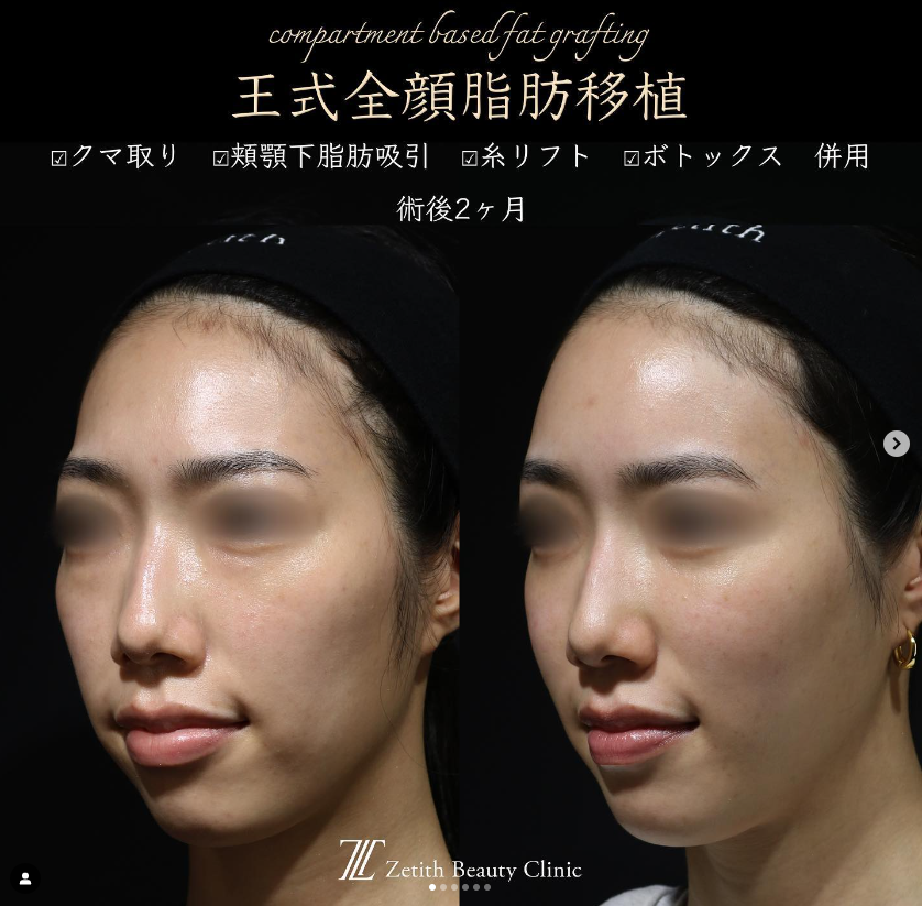 王医師による複合治療の施術前／施術後2ヶ月