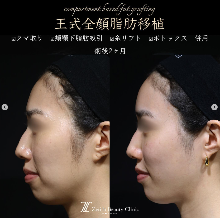 王医師による複合治療の施術前／施術後2ヶ月 施術後 