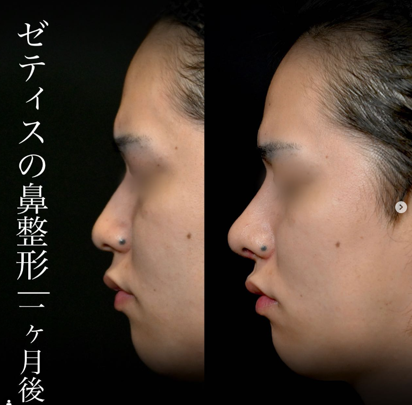 守屋医師による鼻整形の施術前／施術後1ヶ月