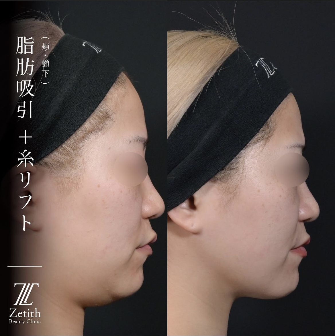 北村医師によるベイザー脂肪吸引(頬・顎下)と糸リフトの施術前／施術後3ヶ月