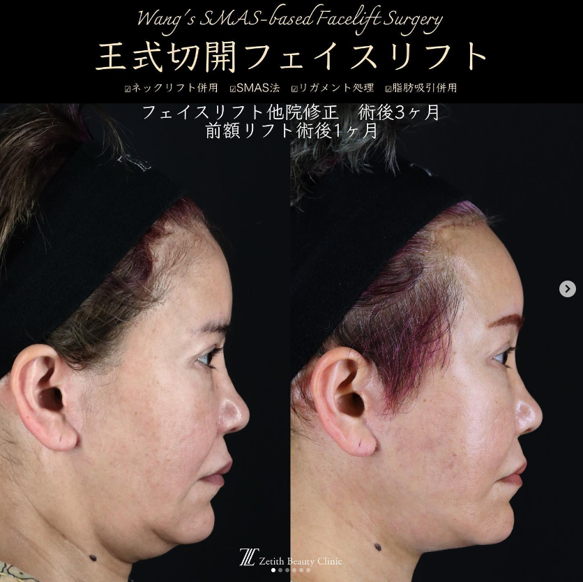 王医師による切開フェイスリフトの施術前／施術後1ヶ月と3ヶ月