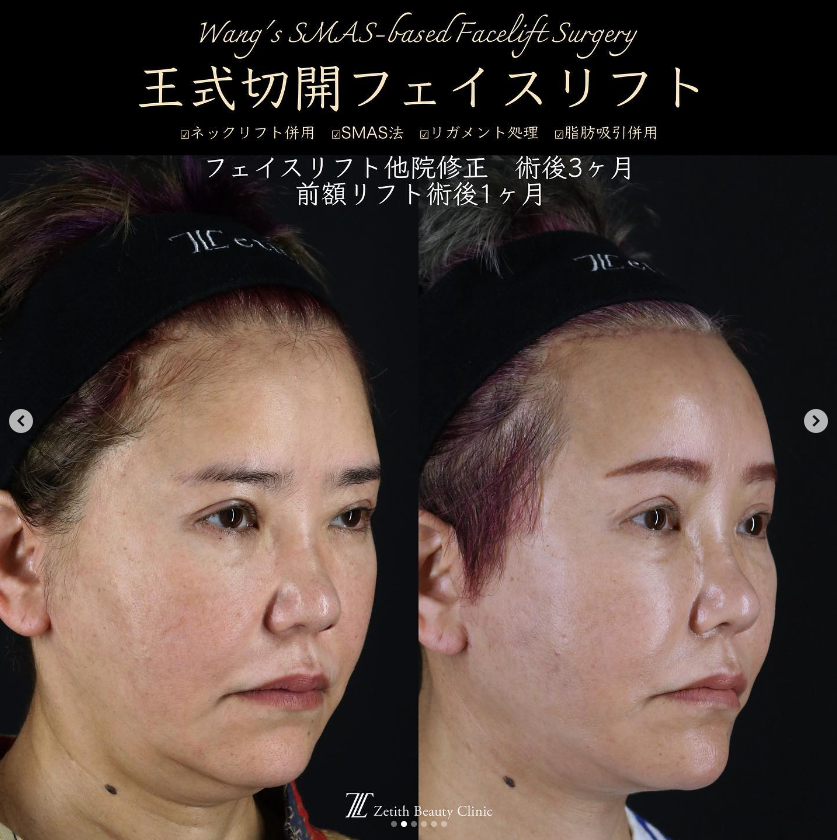 王医師による切開フェイスリフトの施術前／施術後1ヶ月と3ヶ月 Sau 