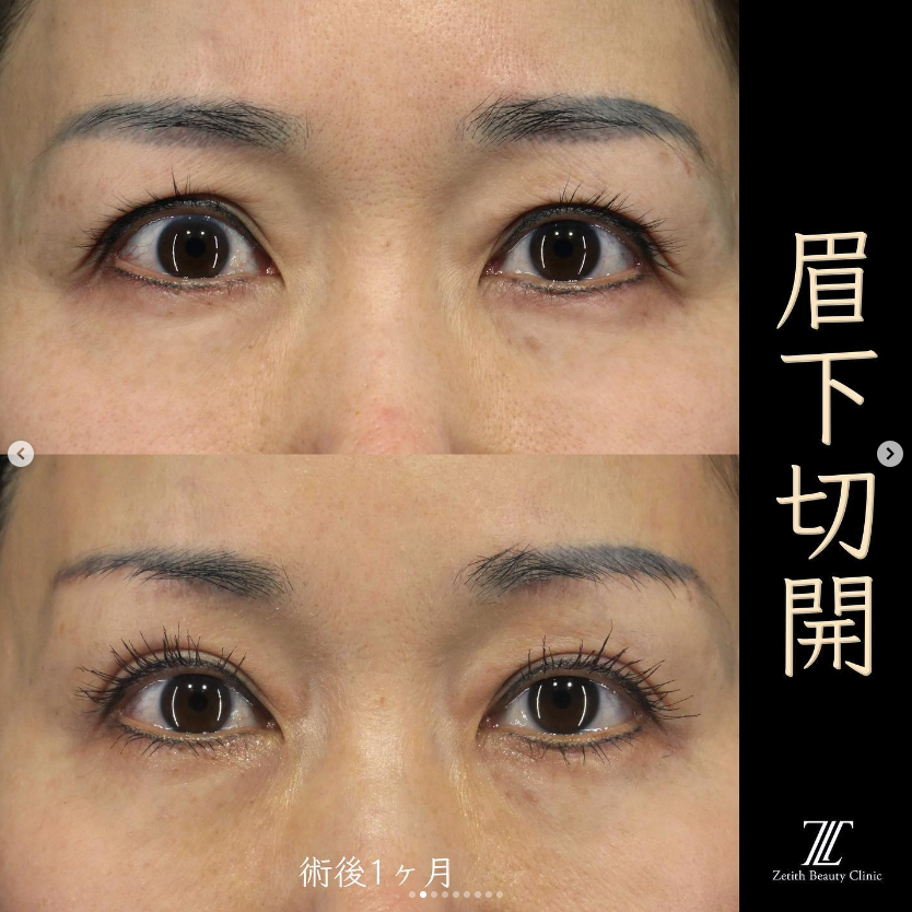 王医師による眉下切開の施術前／施術後1ヶ月