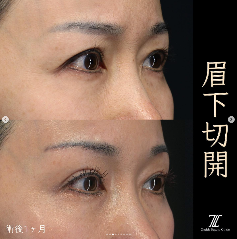 王医師による眉下切開の施術前／施術後1ヶ月 After 