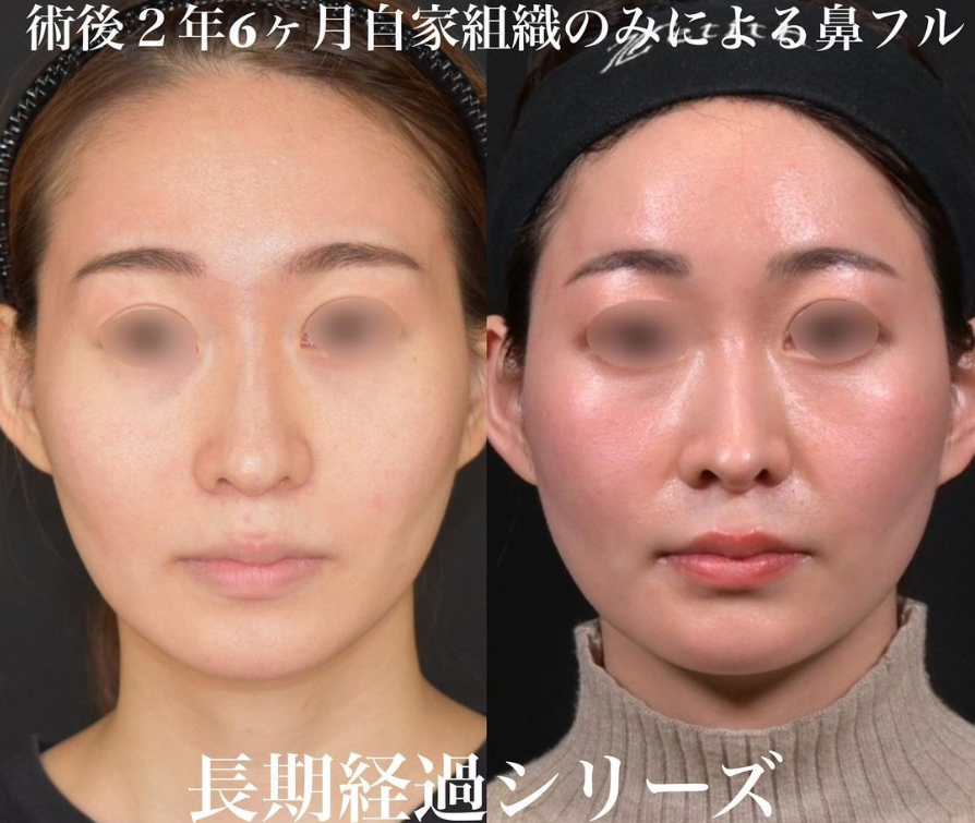 鉄医師による鼻フルコースの施術前／施術後2年6ヶ月 施術後 