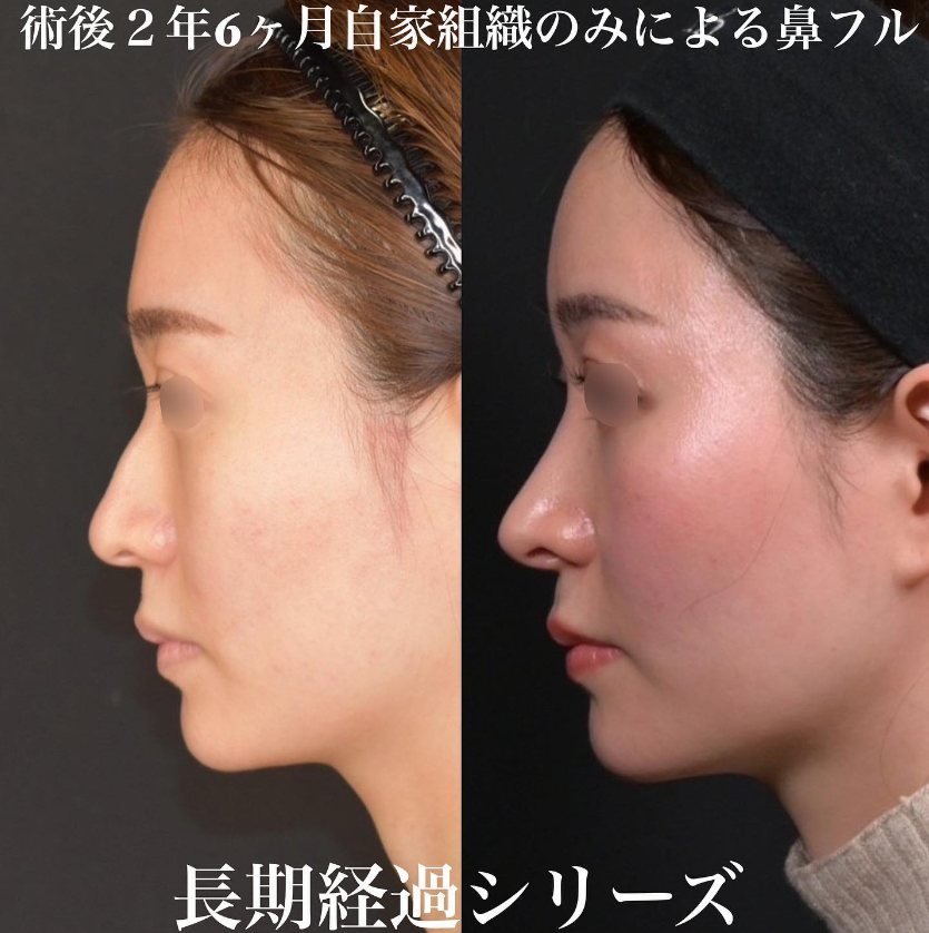 鉄医師による鼻フルコースの施術前／施術後2年6ヶ月