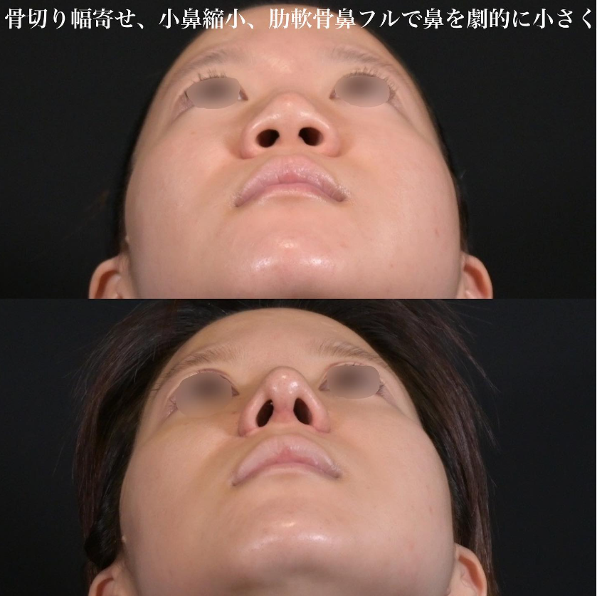 鉄医師による鼻フルコースの施術前／施術後2週間