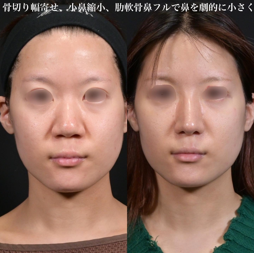 鉄医師による鼻フルコースの施術前／施術後2週間 施術後 