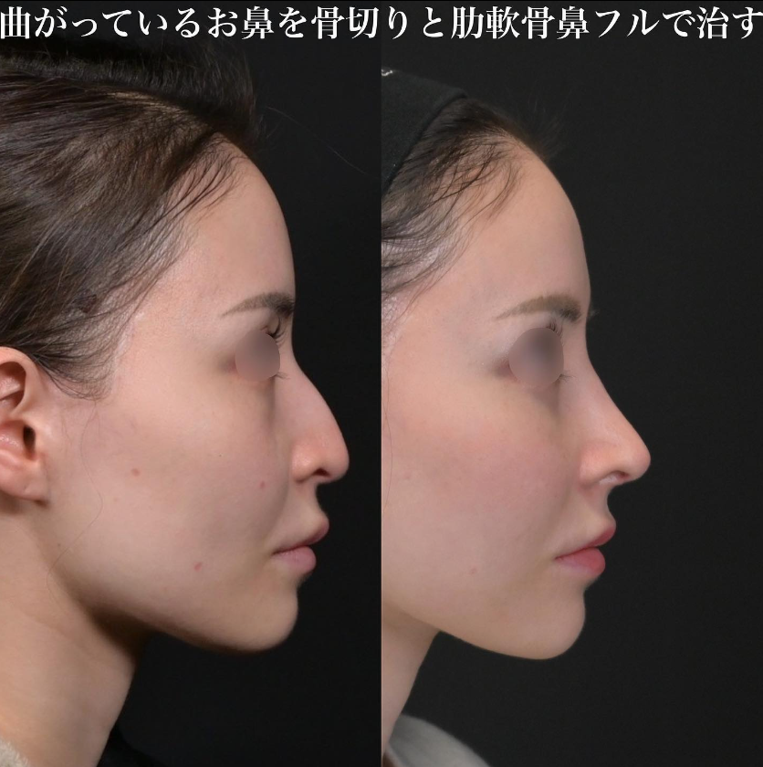 鉄医師による鼻フルコースの施術前／施術後1ヶ月