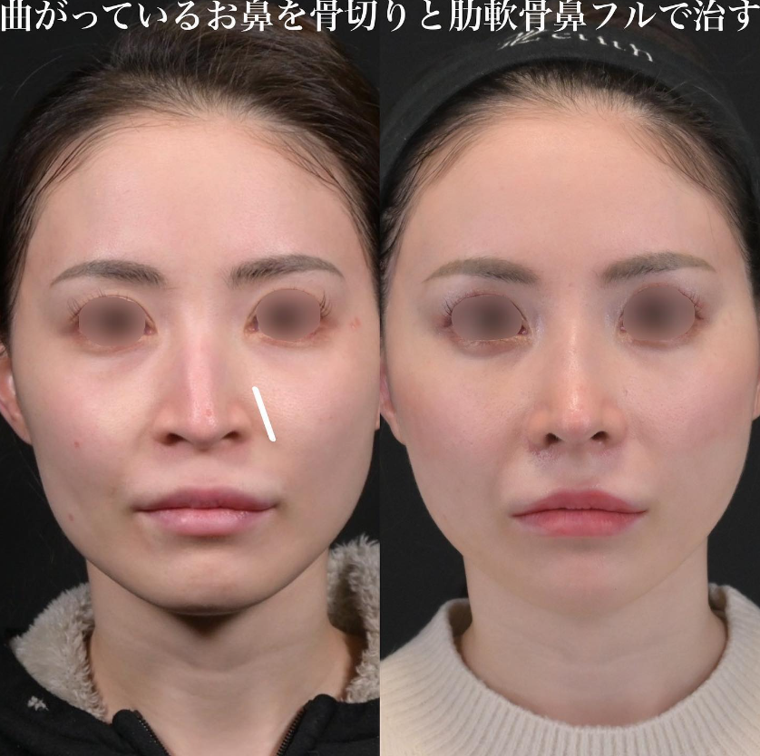 鉄医師による鼻フルコースの施術前／施術後1ヶ月 施術後 