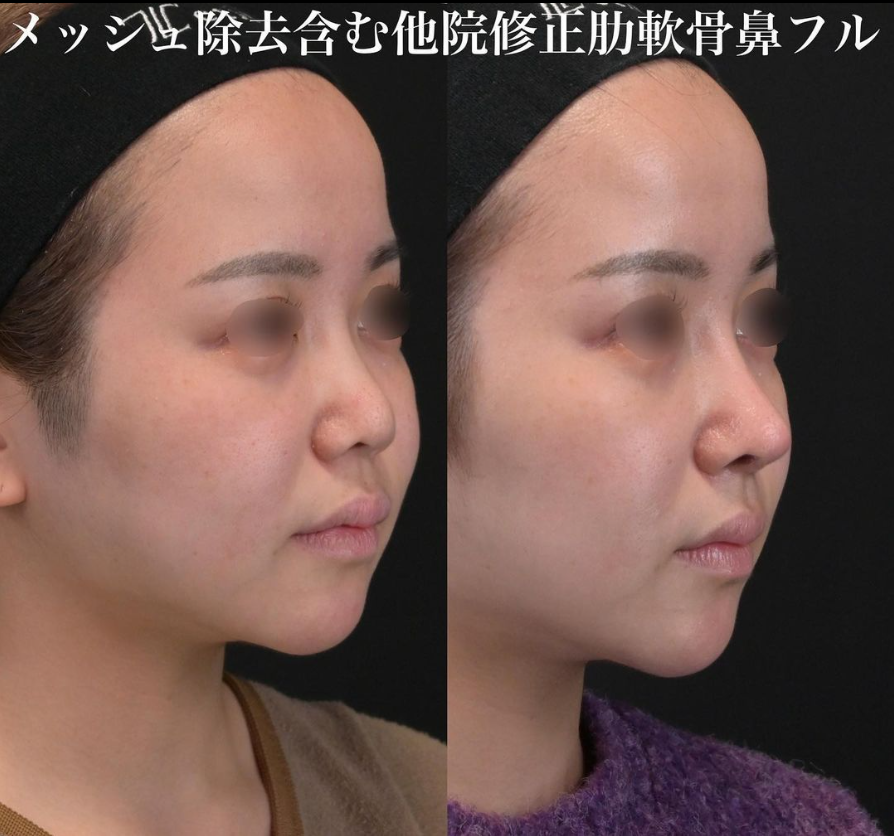鉄医師による鼻フルコースの施術前／施術後1ヶ月
