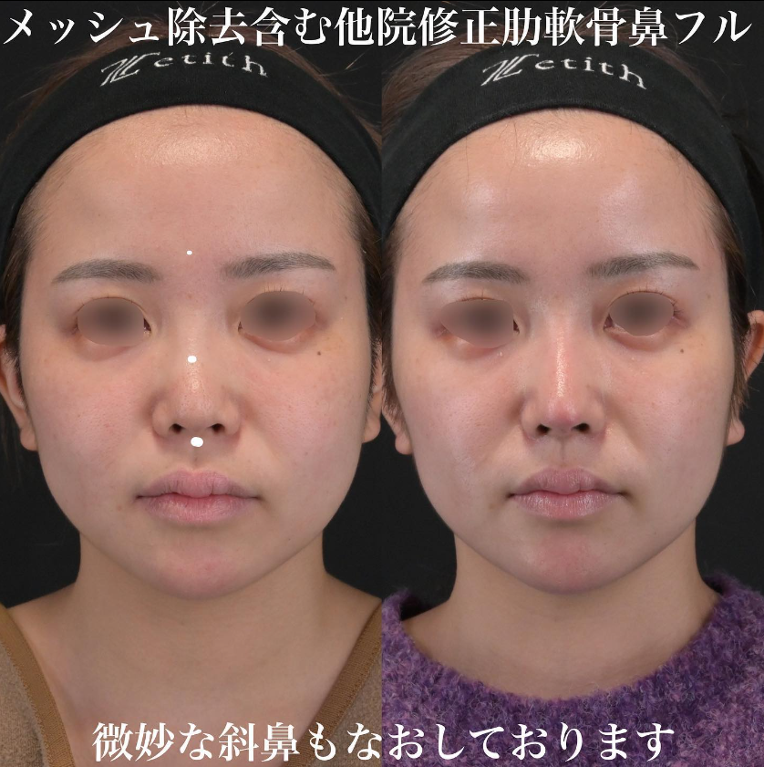 鉄医師による鼻フルコースの施術前／施術後1ヶ月 Дараа 