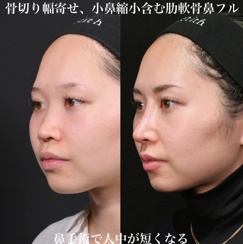鉄医師による鼻フルコースの施術前／施術後1ヶ月