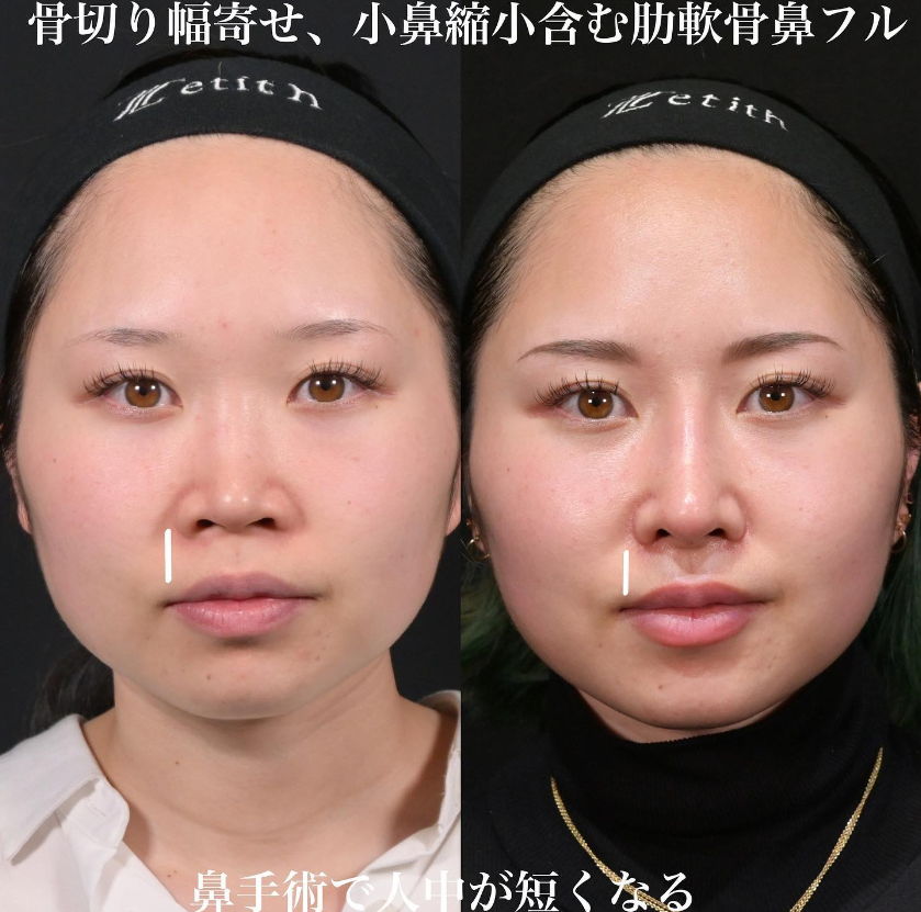 鉄医師による鼻フルコースの施術前／施術後1ヶ月 施術後 