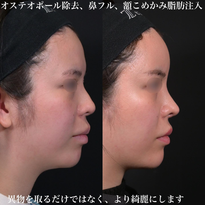 鉄医師による鼻フルコースの施術前／施術後3ヶ月