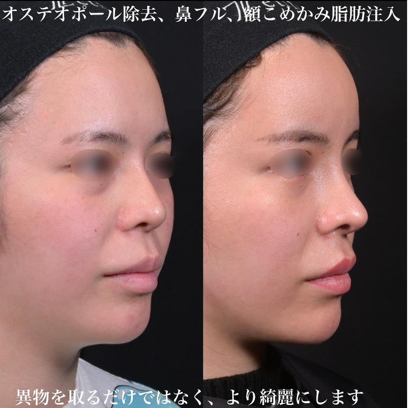 鉄医師による鼻フルコースの施術前／施術後3ヶ月 施術後 