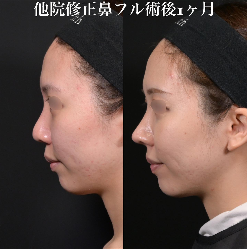 鉄医師による鼻フルコースの施術前／施術後1ヶ月