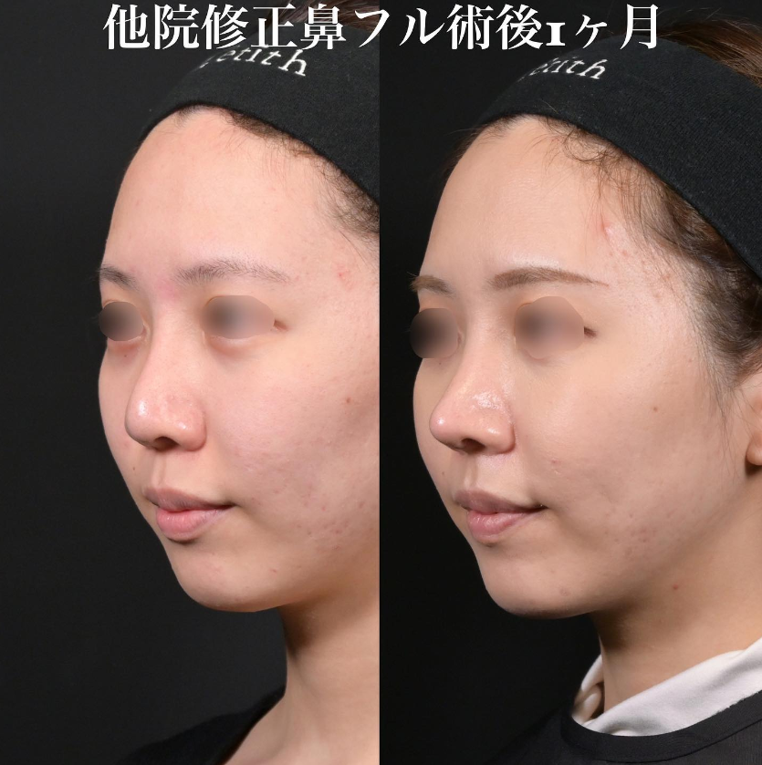 鉄医師による鼻フルコースの施術前／施術後1ヶ月 术后 