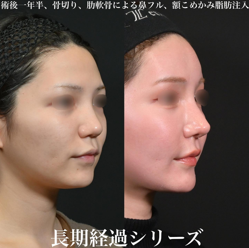 鉄先生による鼻フルコースの施術前／施術後1年6ヶ月
