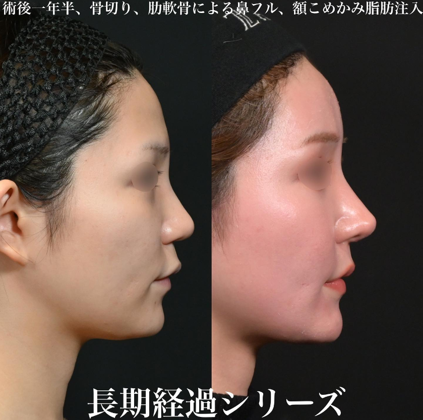鉄先生による鼻フルコースの施術前／施術後1年6ヶ月 施術後 
