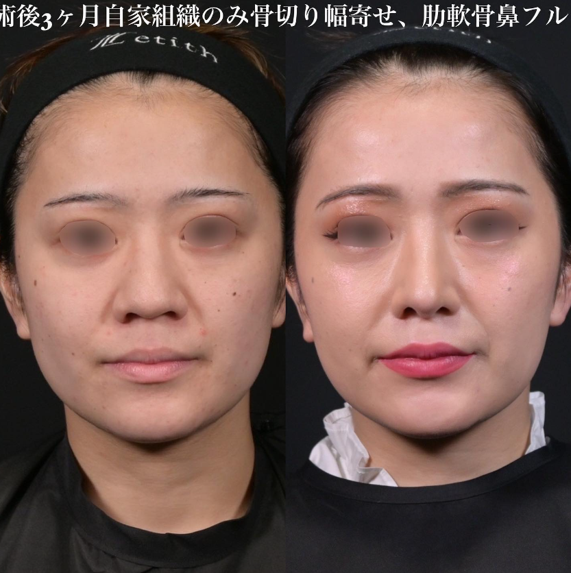 鉄医師による鼻のフルコースの施術前／施術後3ヶ月