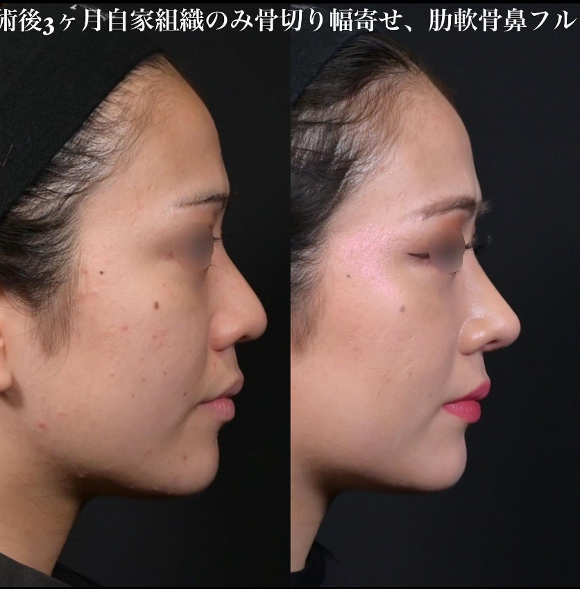 鉄医師による鼻のフルコースの施術前／施術後3ヶ月 Sau 