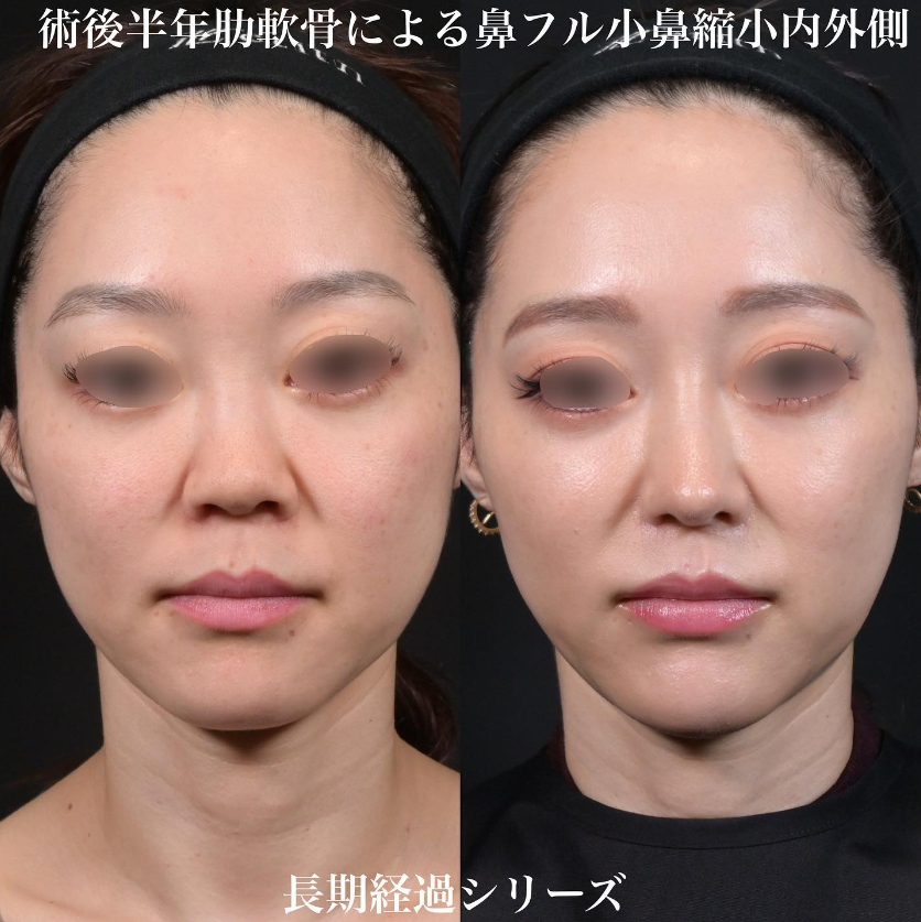 鉄医師による鼻のフルコースの施術前／施術後6ヶ月