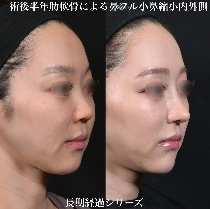 鉄医師による鼻のフルコースの施術前／施術後6ヶ月 Дараа 