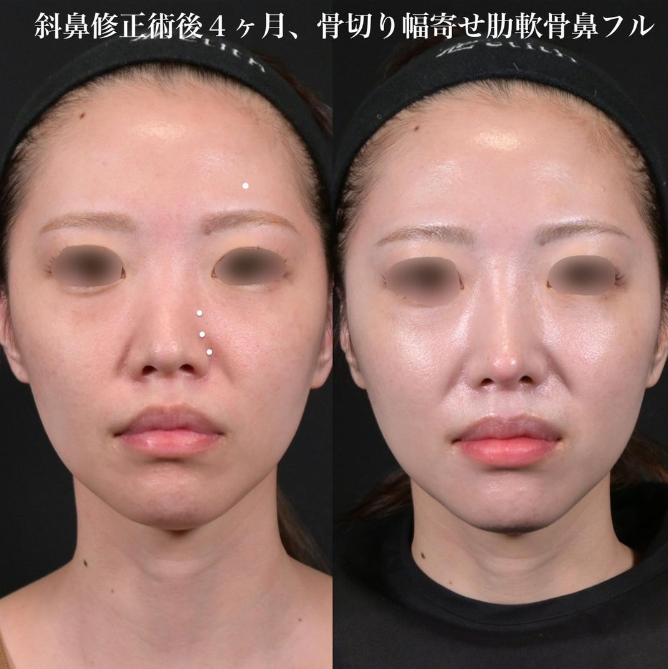 鉄医師による鼻のフルコースの施術前／施術後4ヶ月