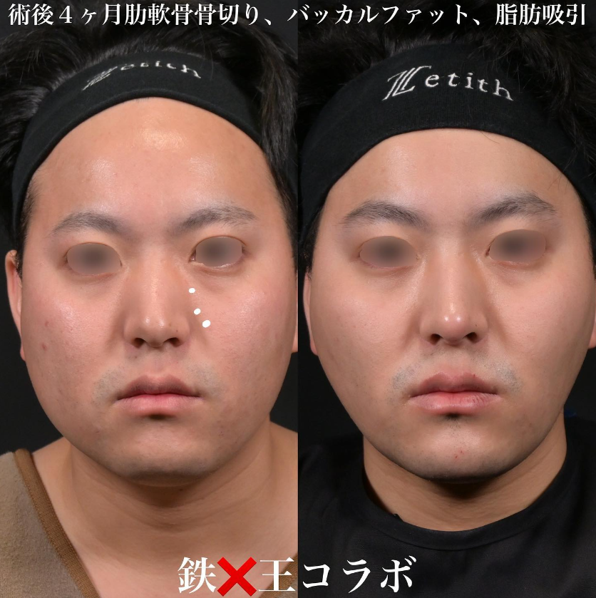 鉄医師による鼻のフルコースの施術前／施術後4ヶ月