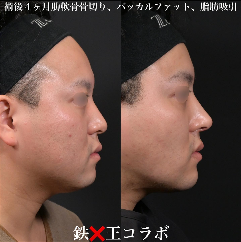 鉄医師による鼻のフルコースの施術前／施術後4ヶ月 施術後 