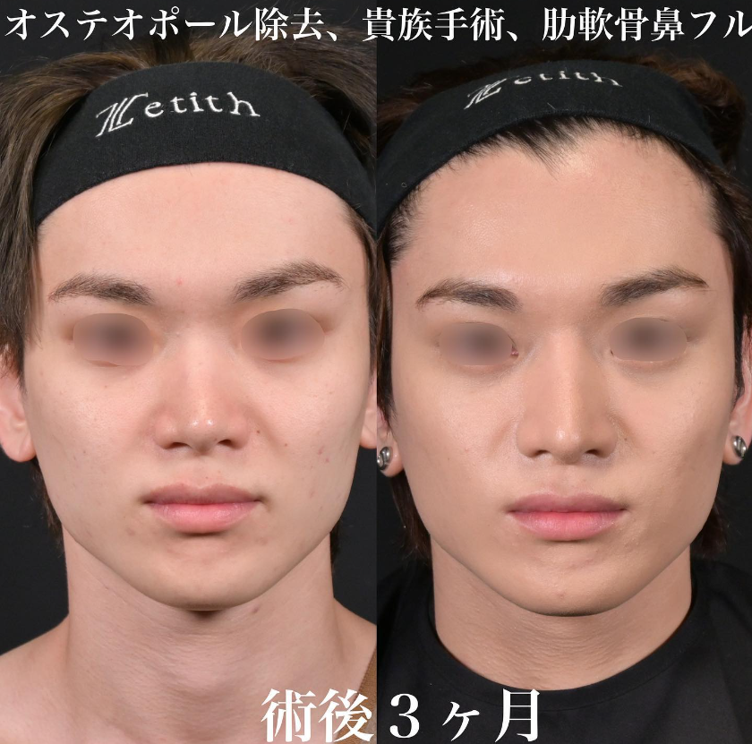 鉄医師による鼻のフルコースの施術前／施術後3ヶ月