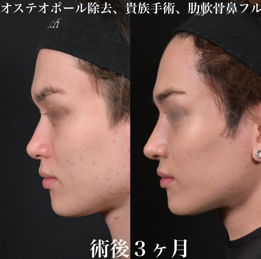 鉄医師による鼻のフルコースの施術前／施術後3ヶ月 بعد 