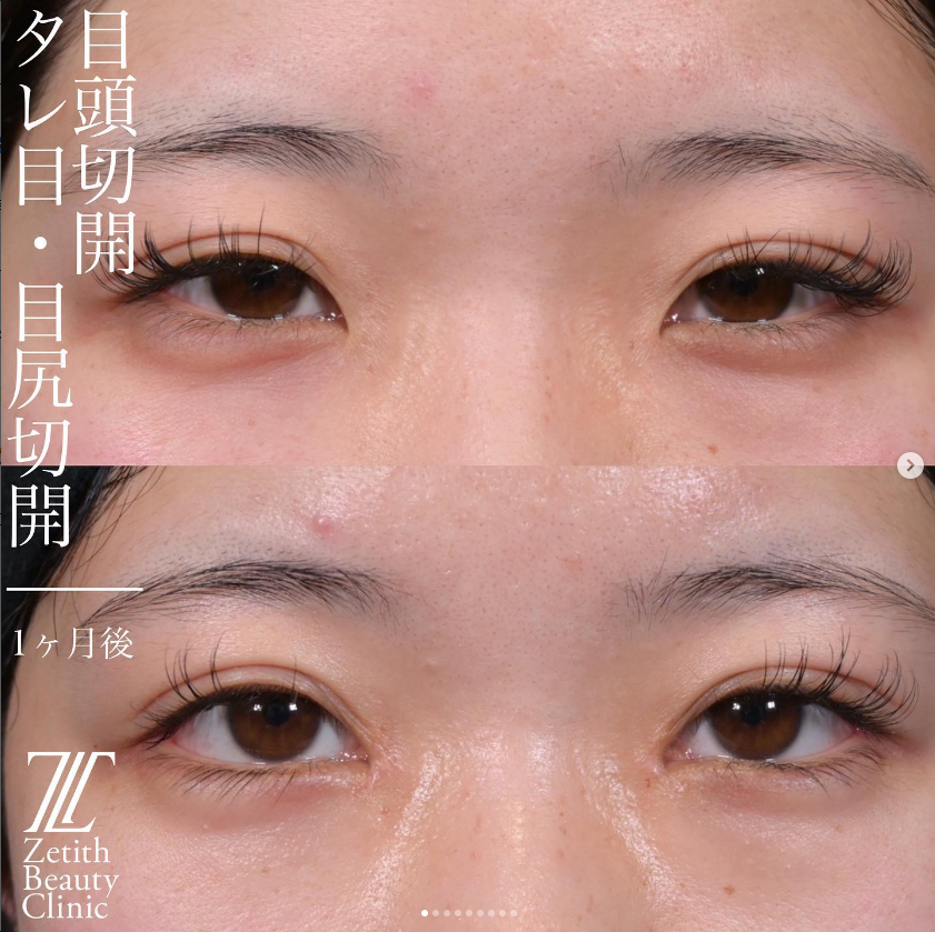 上木原医師による目元複合手術の施術前／施術後1ヶ月