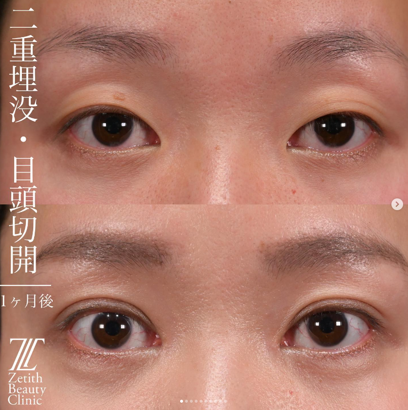 上木原医師による目元複合手術の施術前／施術後1ヶ月