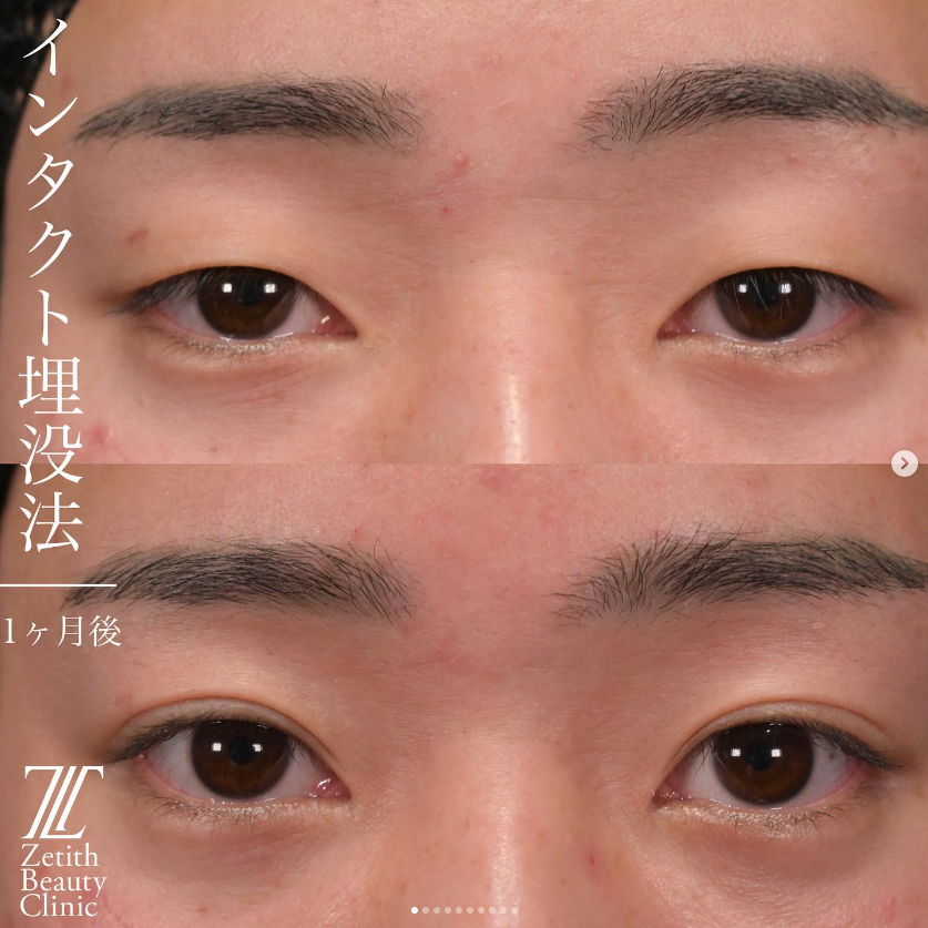 上木原医師による二重埋没法の施術前／施術後1ヶ月