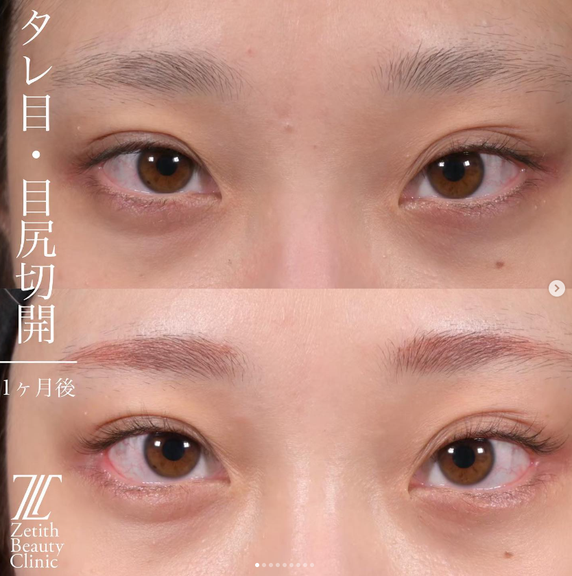 上木原医師による目元複合手術の施術前／施術後1ヶ月