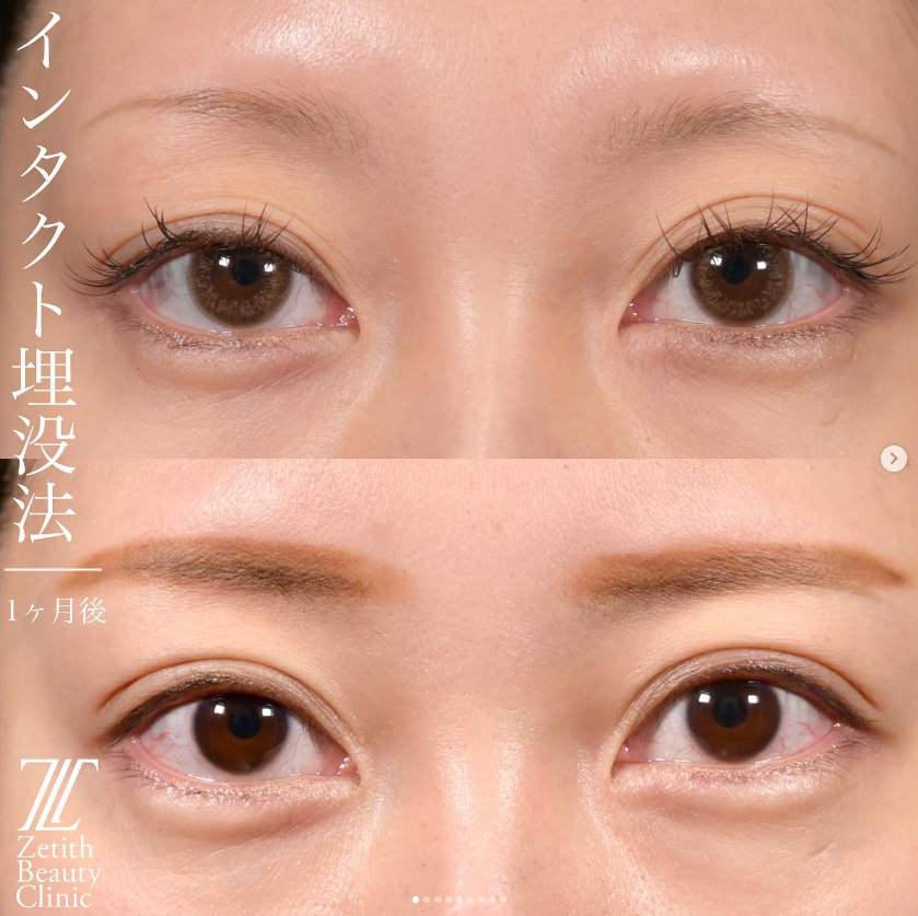 上木原医師による二重埋没法の施術前／施術後1ヶ月