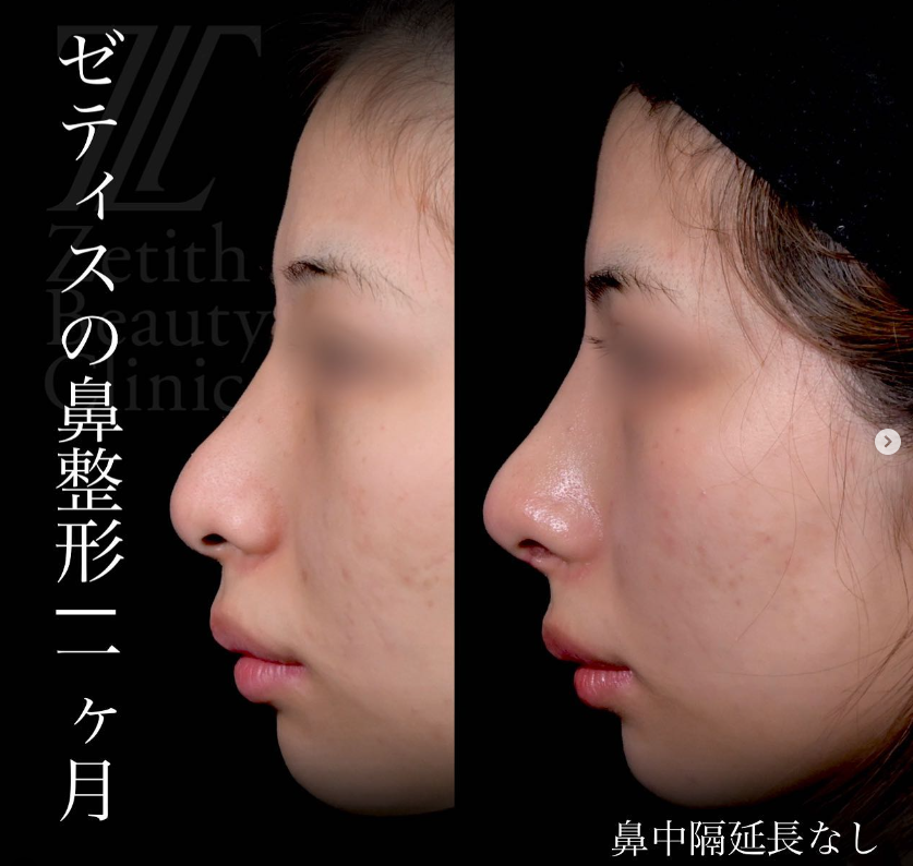 守屋医師による鼻整形の施術前／施術後1ヶ月