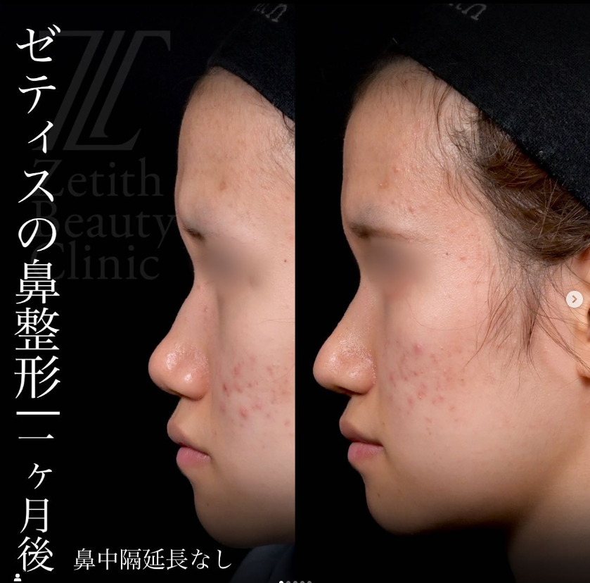 守屋医師による鼻整形の施術前／施術後1ヶ月